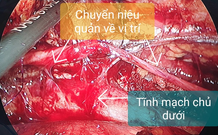 sau pt